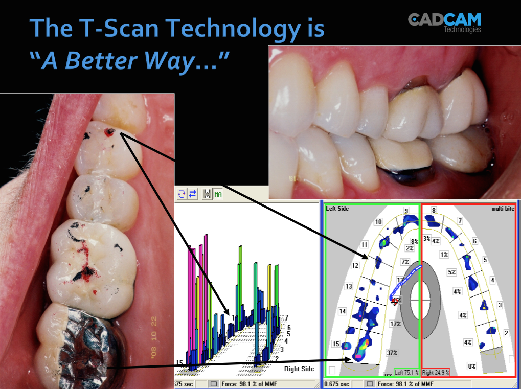 Use your dentist ARTICULATION PAPER ONLY? Take the guesswork out of