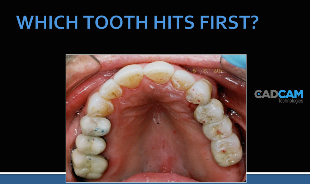 Use your dentist ARTICULATION PAPER ONLY? Take the guesswork out of