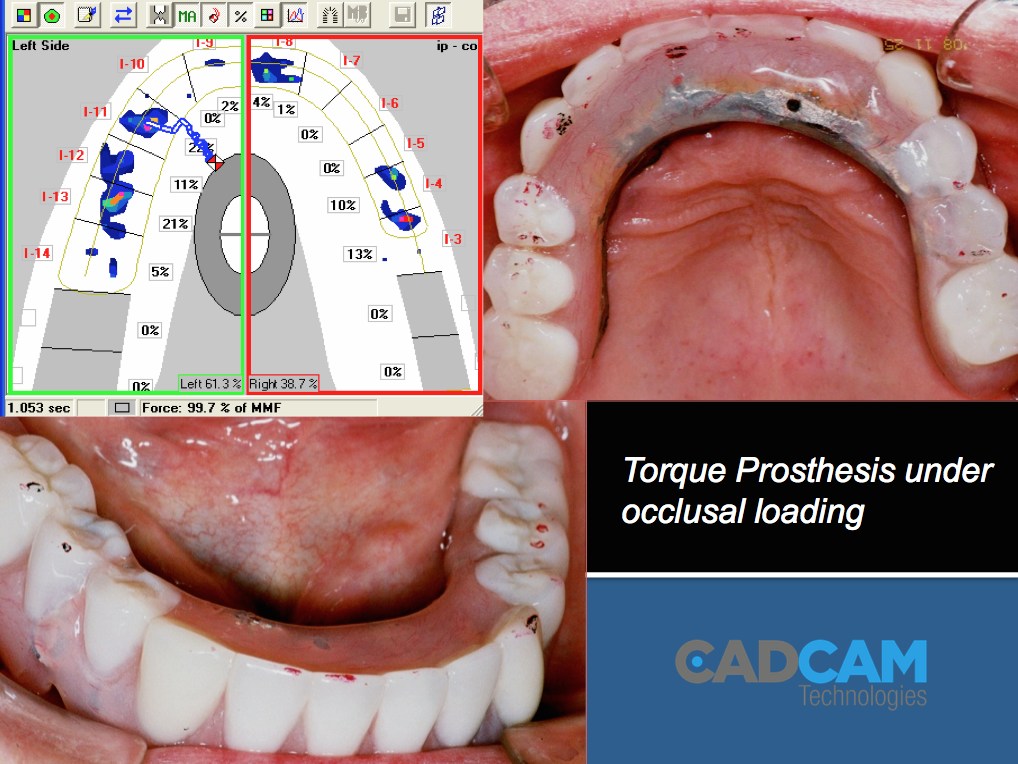 Use your dentist ARTICULATION PAPER ONLY? Take the guesswork out of
