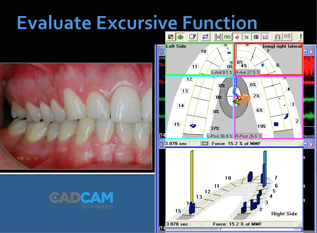 Use your dentist ARTICULATION PAPER ONLY? Take the guesswork out of