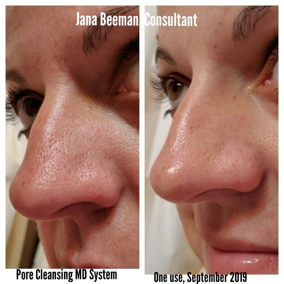 rodan and fields pore sucker
